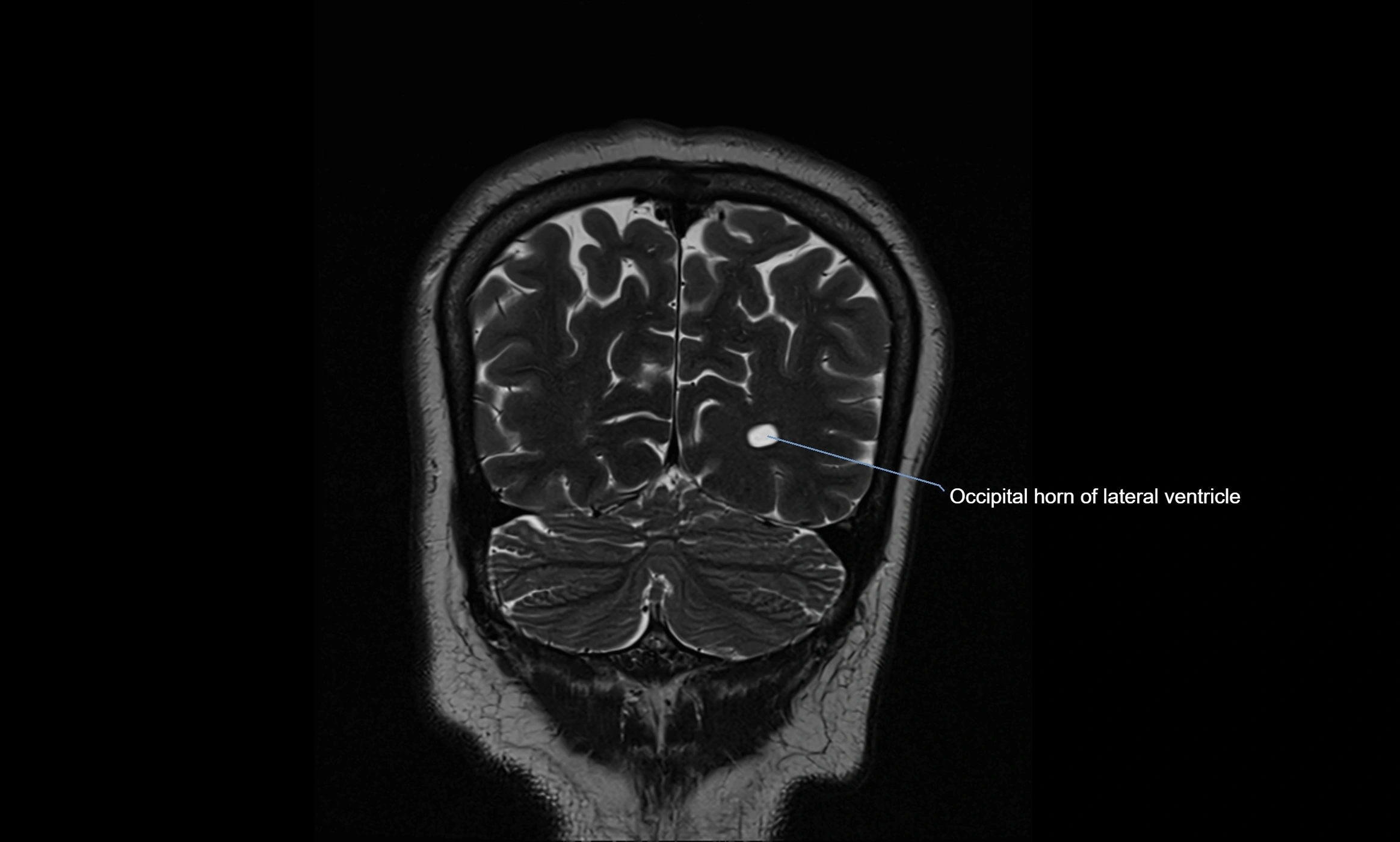 Brain cisterns  and ventricles coronal anatomy 3T MRI image-img-00001-00052.webp